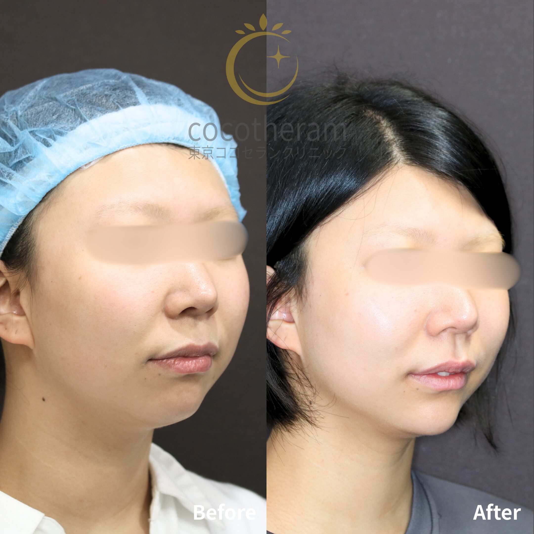 スレッドリフト