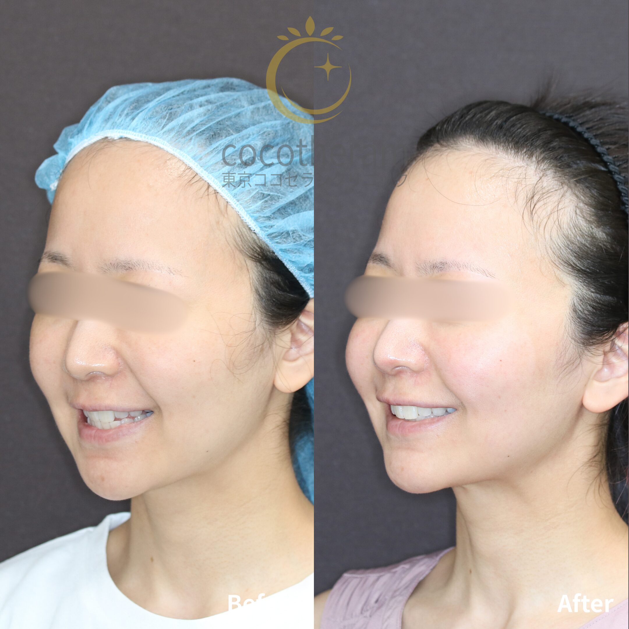 スレッドリフト