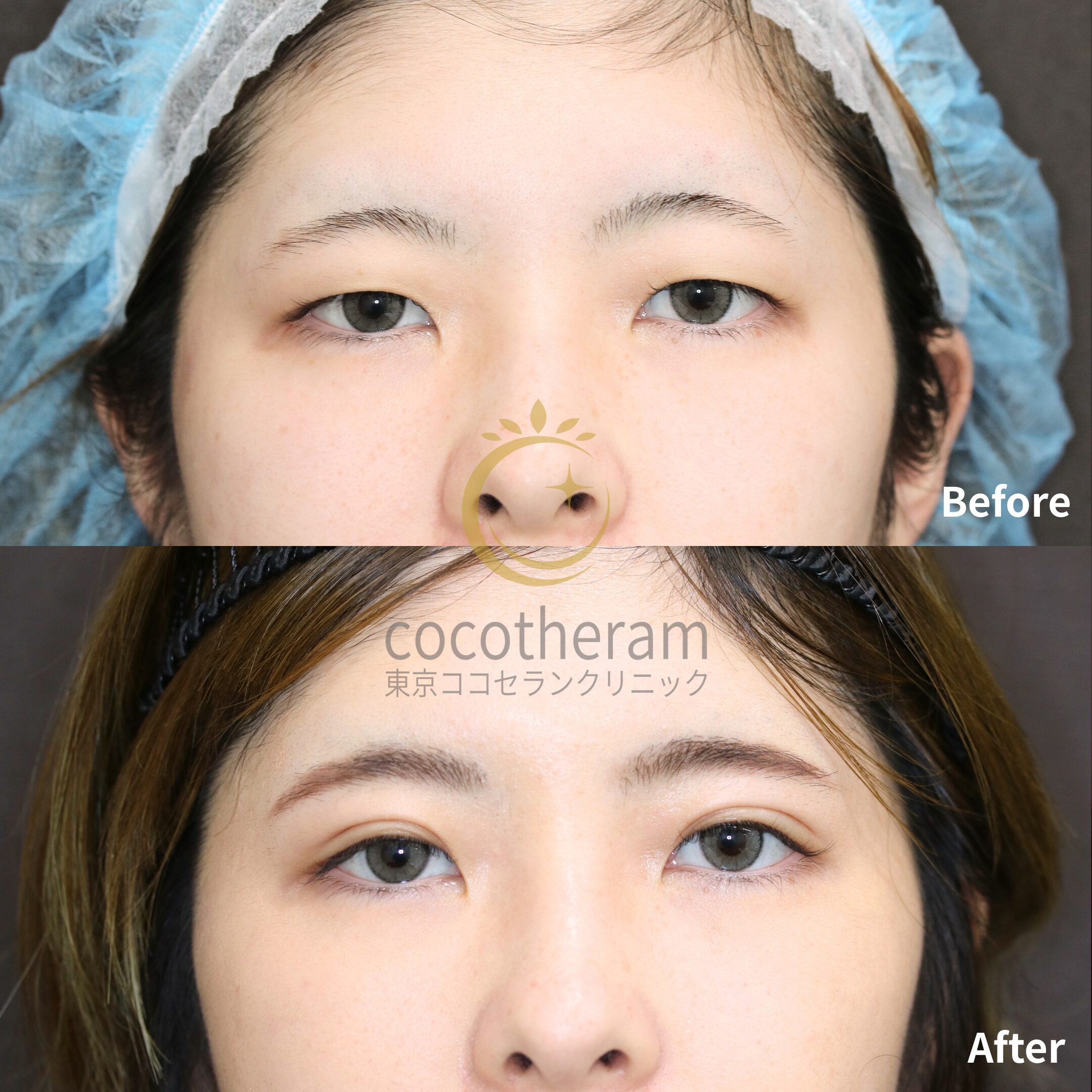 二重埋没法6点留め