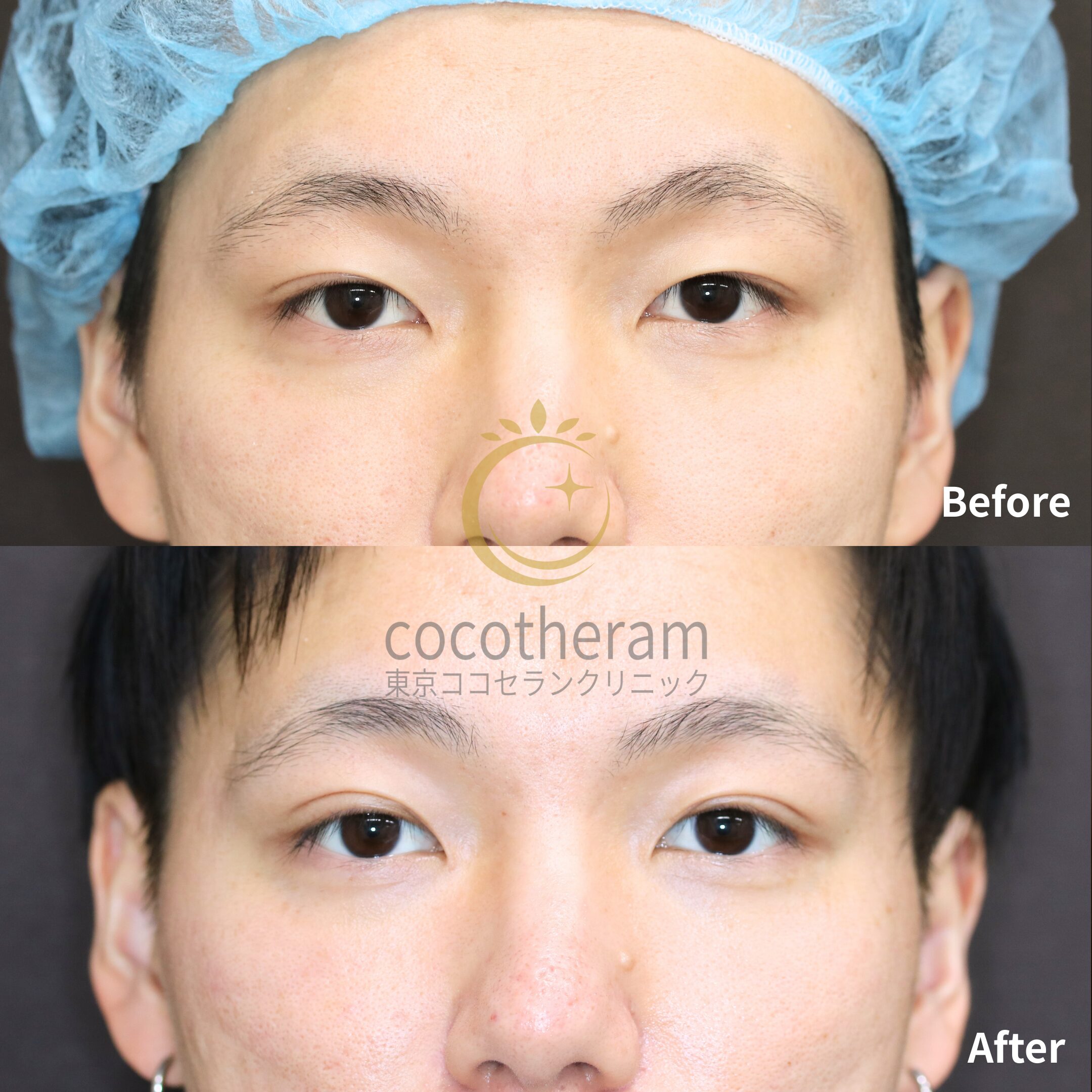 二重埋没法6点留め