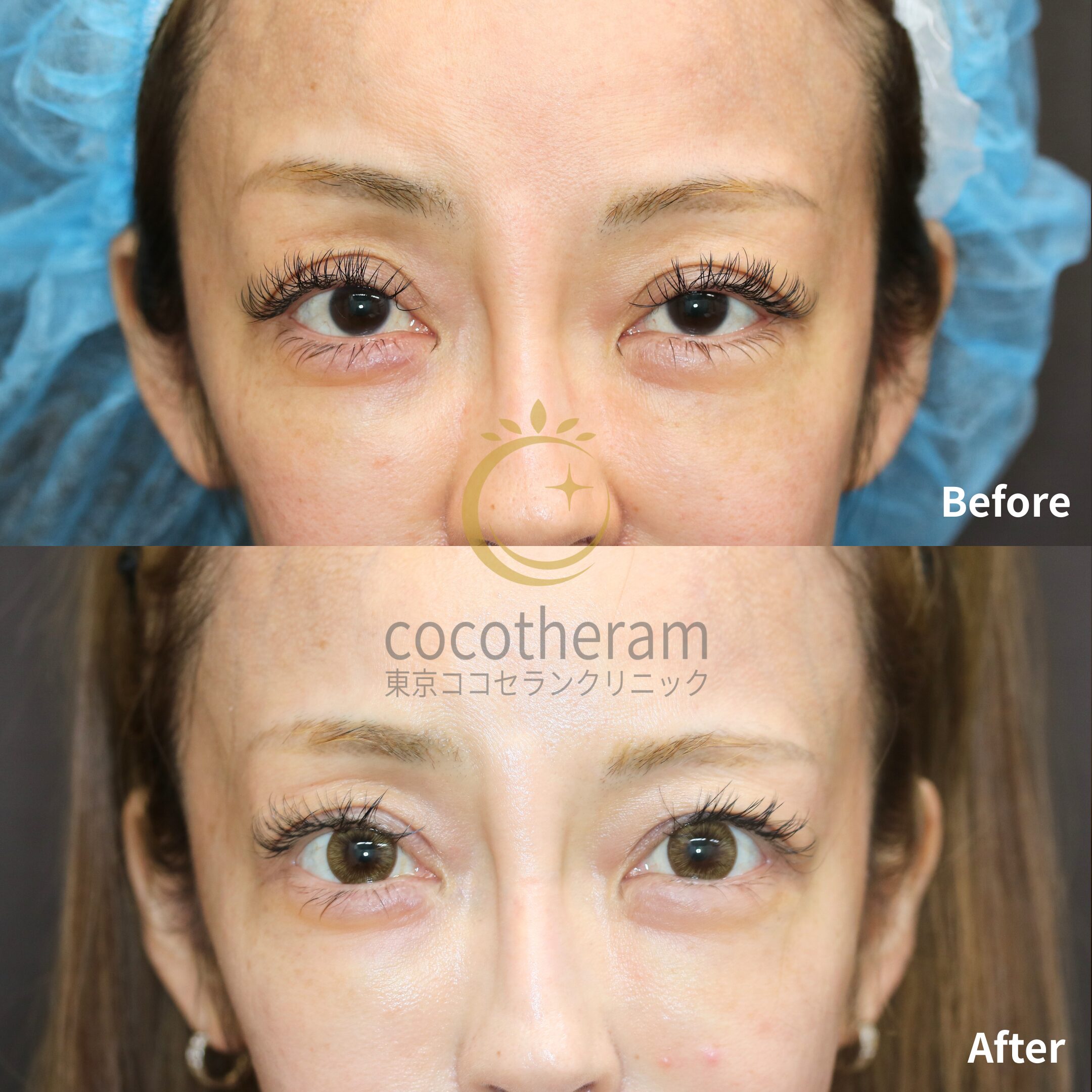 眼瞼下垂症手術 / 二重埋没抜糸法