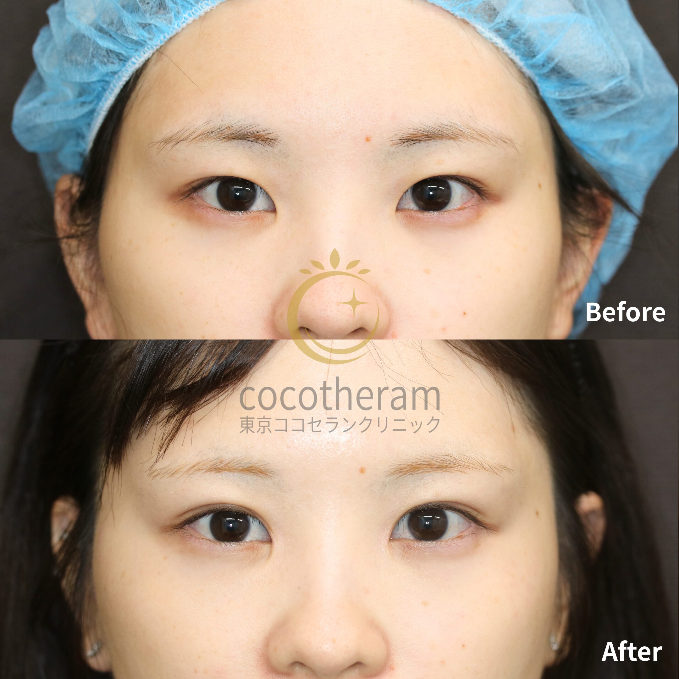 二重埋没法3点留め / 目頭切開