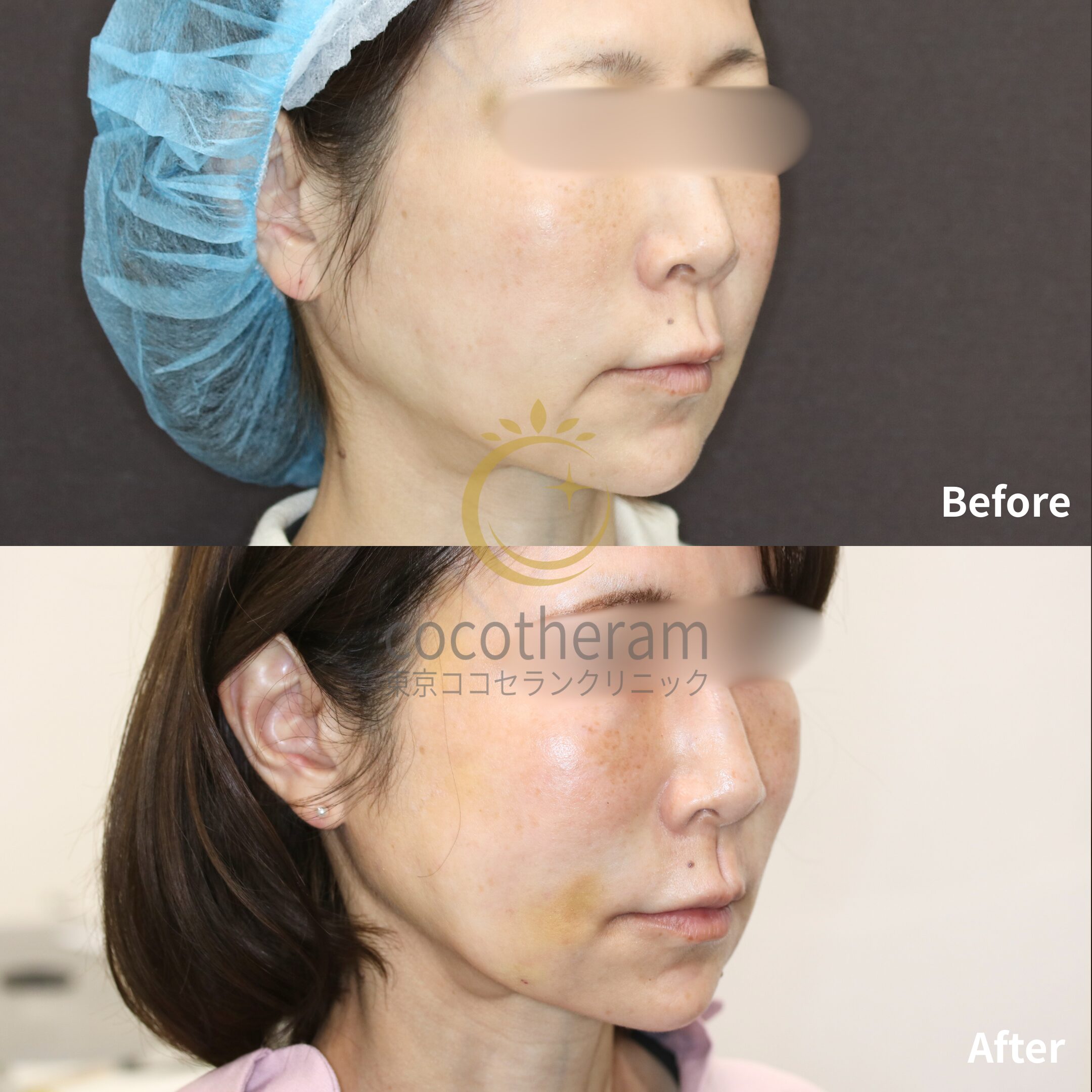 スレッドリフト