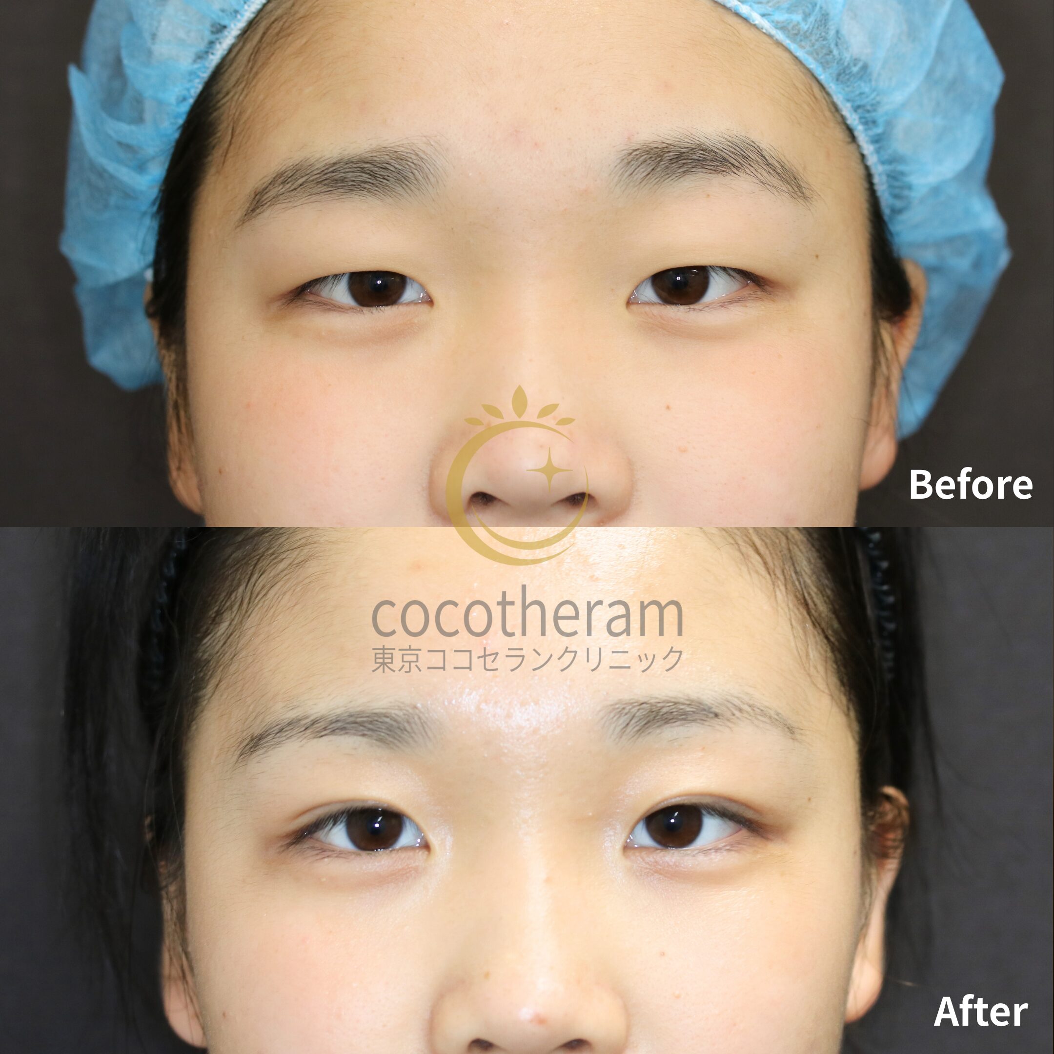 二重埋没法6点留め