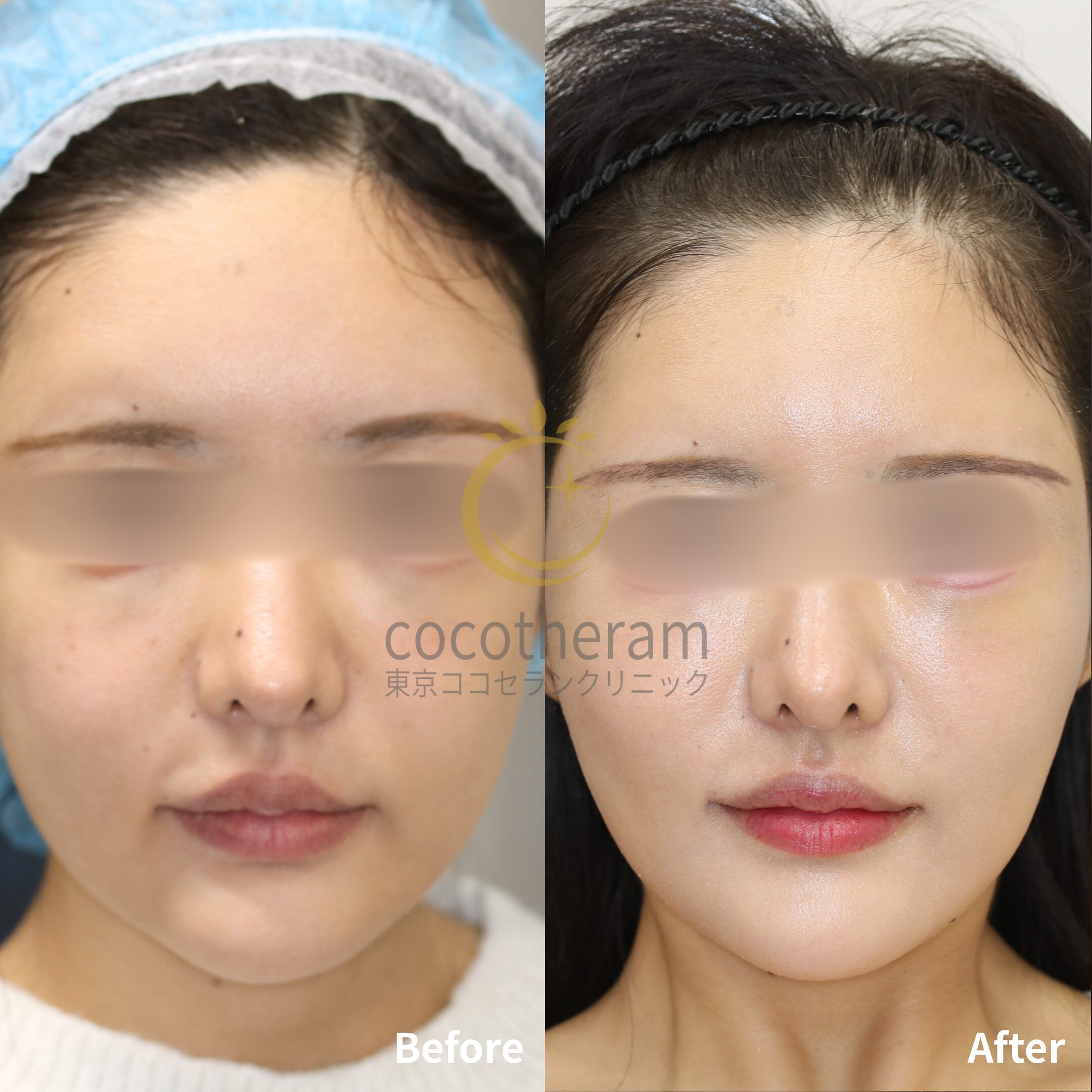 スレッドリフト