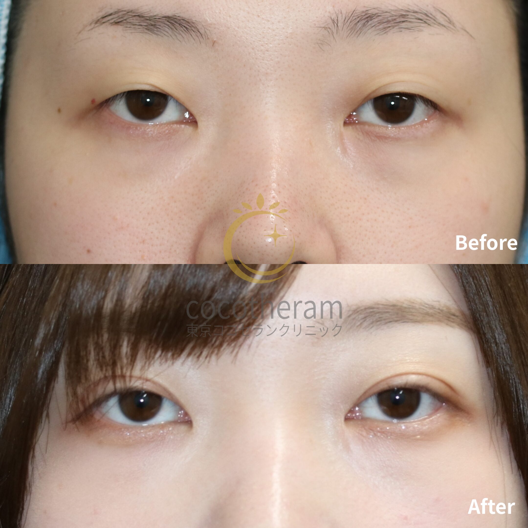 二重埋没法3点留め