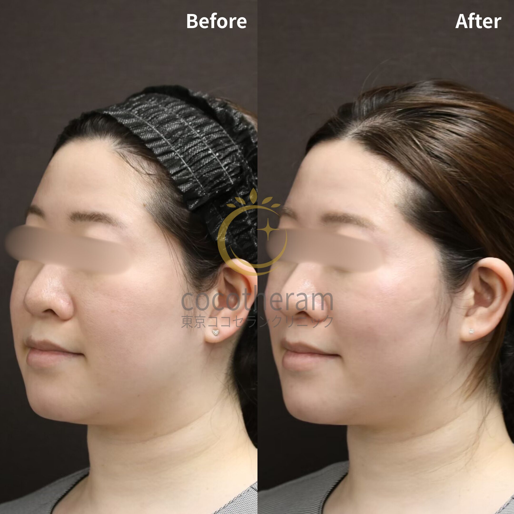 スレッドリフト