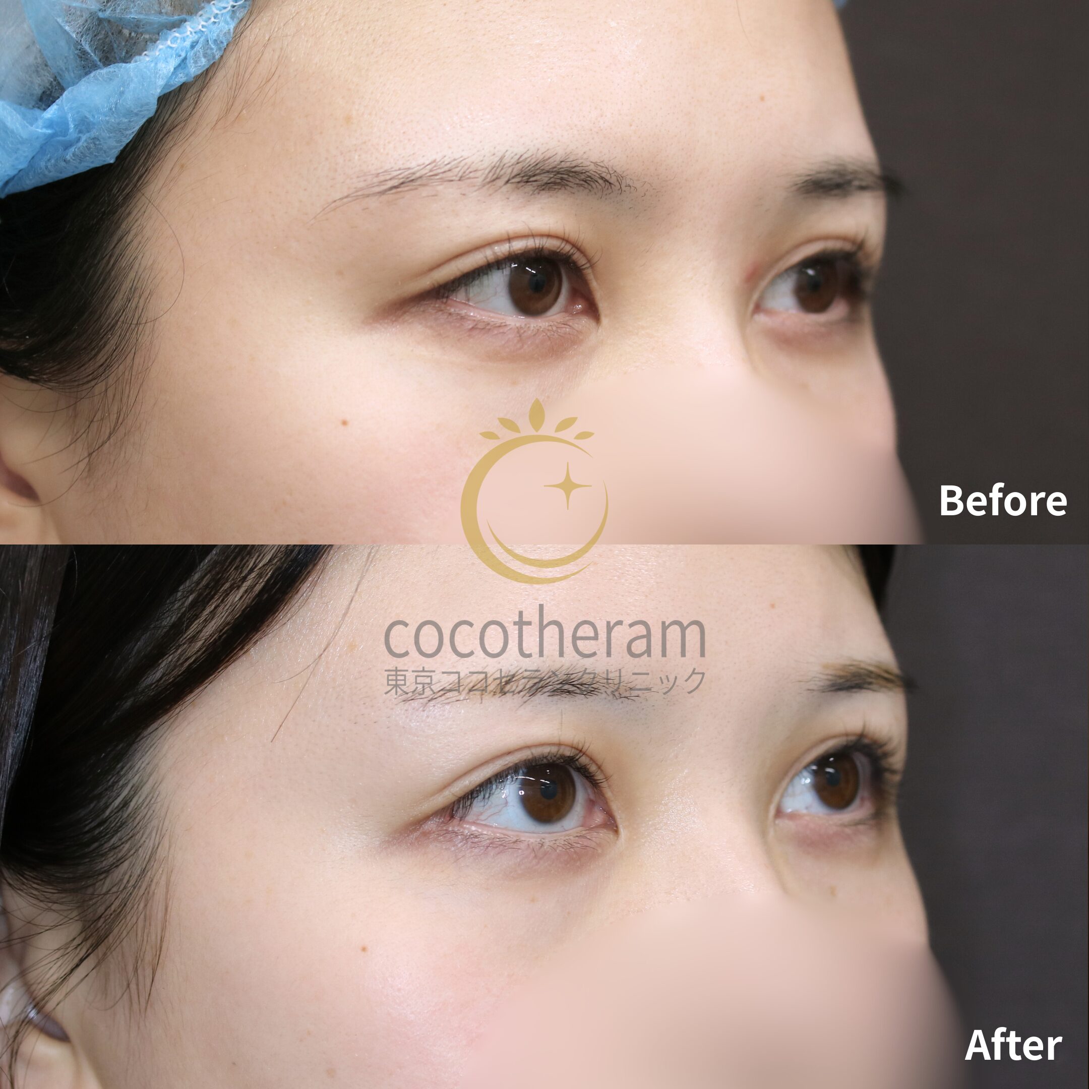 目尻切開 / グラマラスライン形成