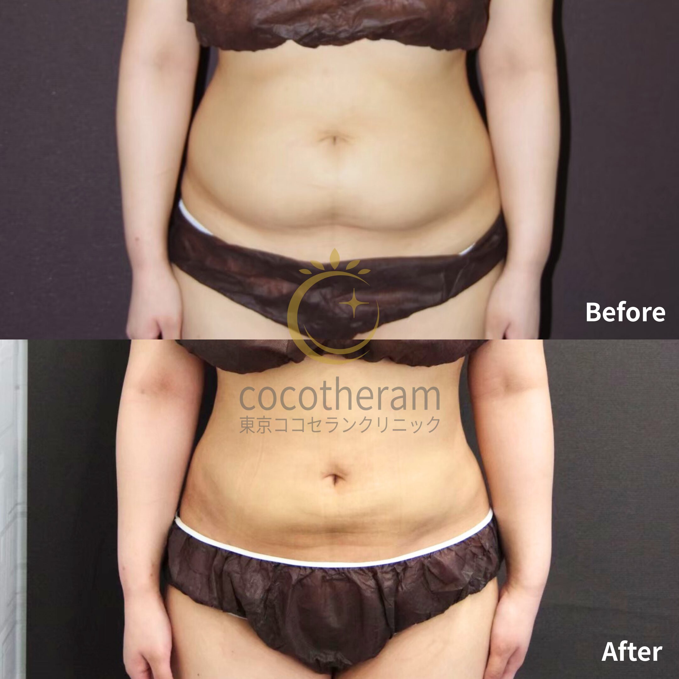 LipoLife脂肪吸引