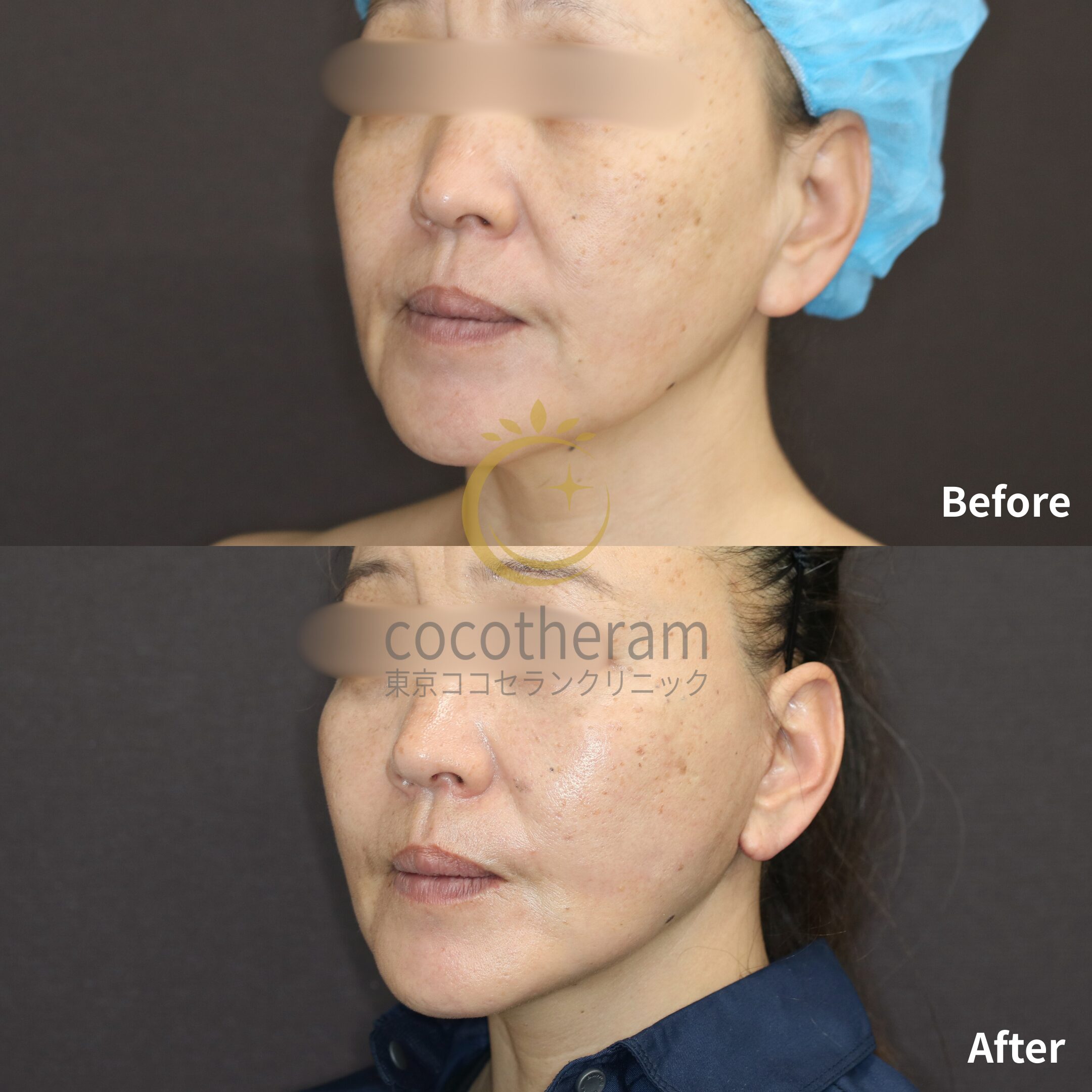 ミッドフェイスリフト / フェイスリフト / 脂肪吸引