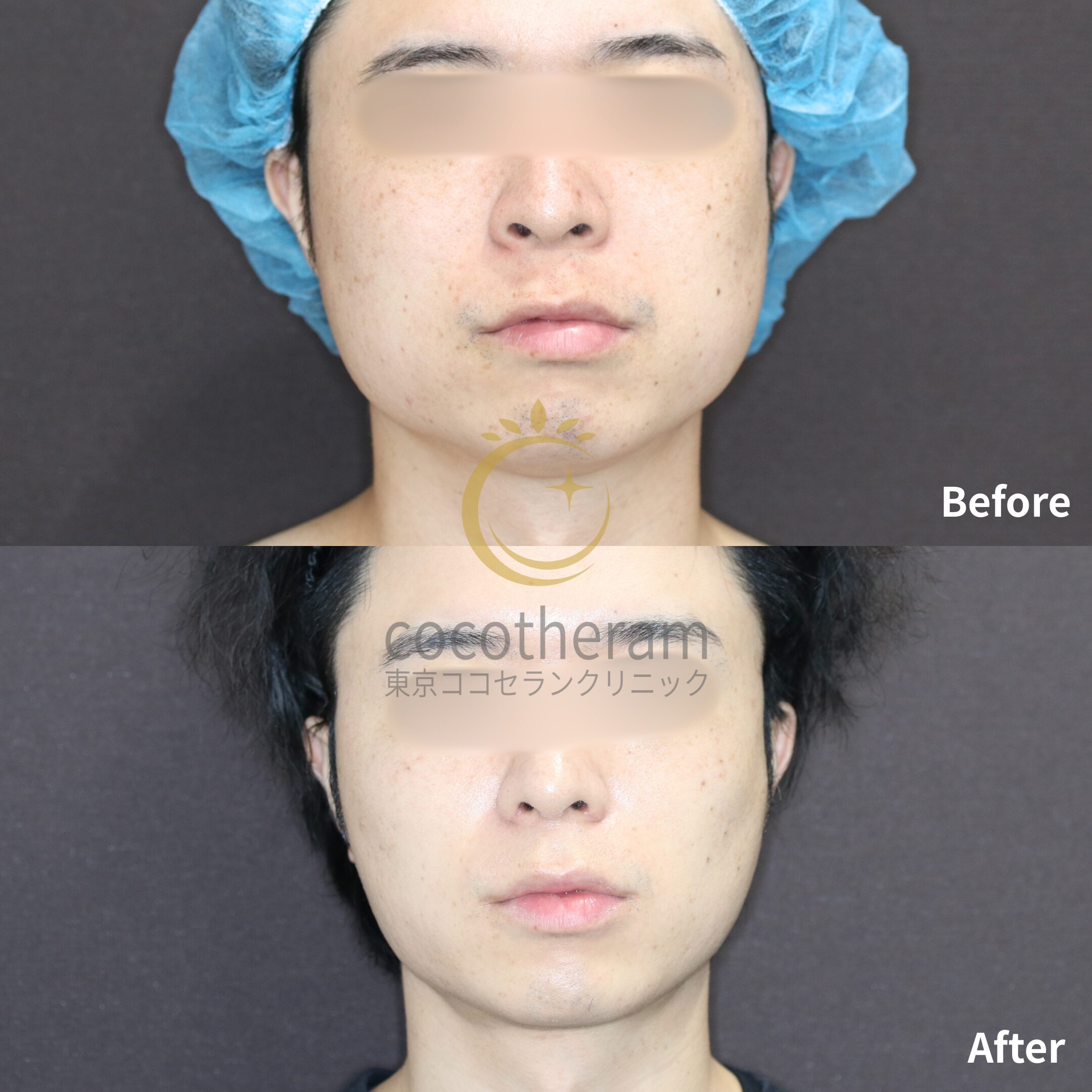 小顔マジック / 脂肪注入