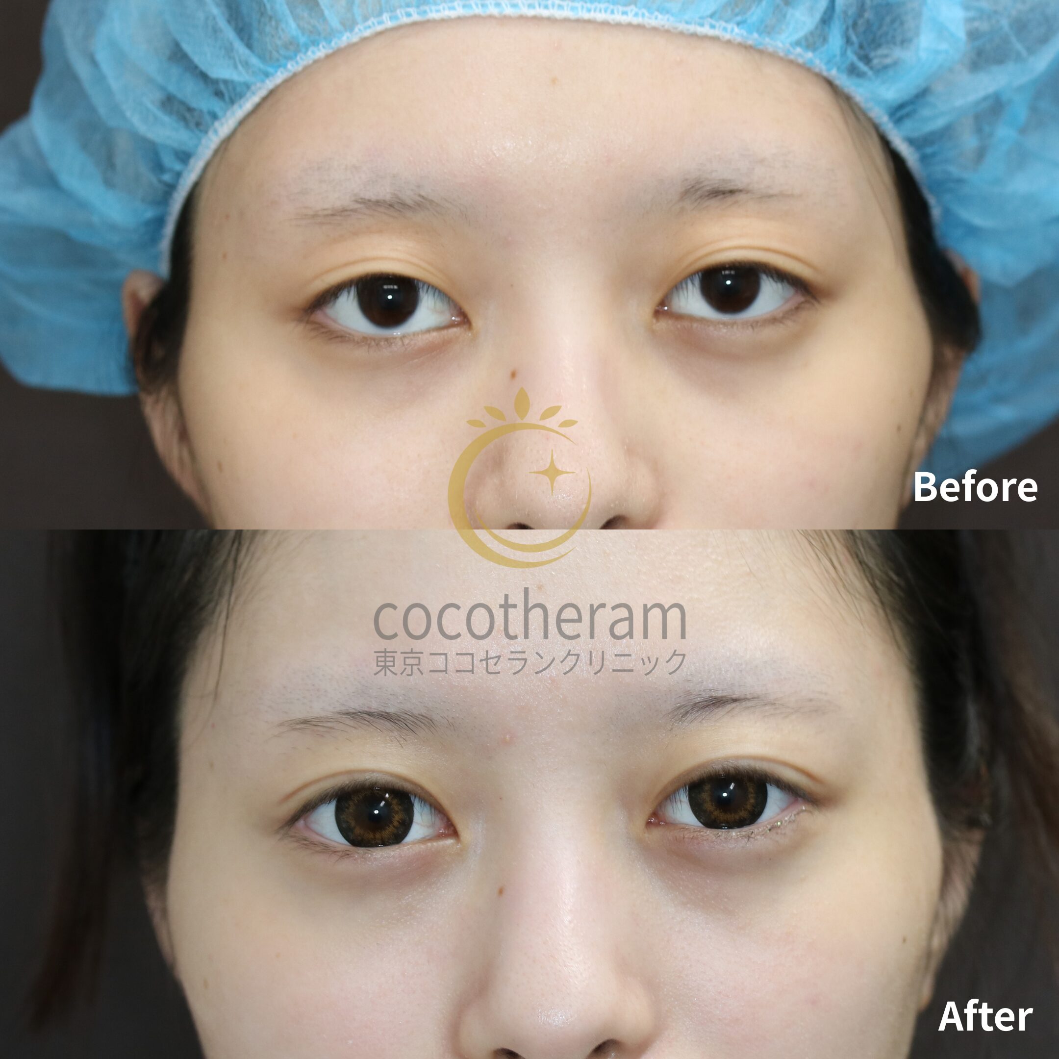 二重埋没法3点留め