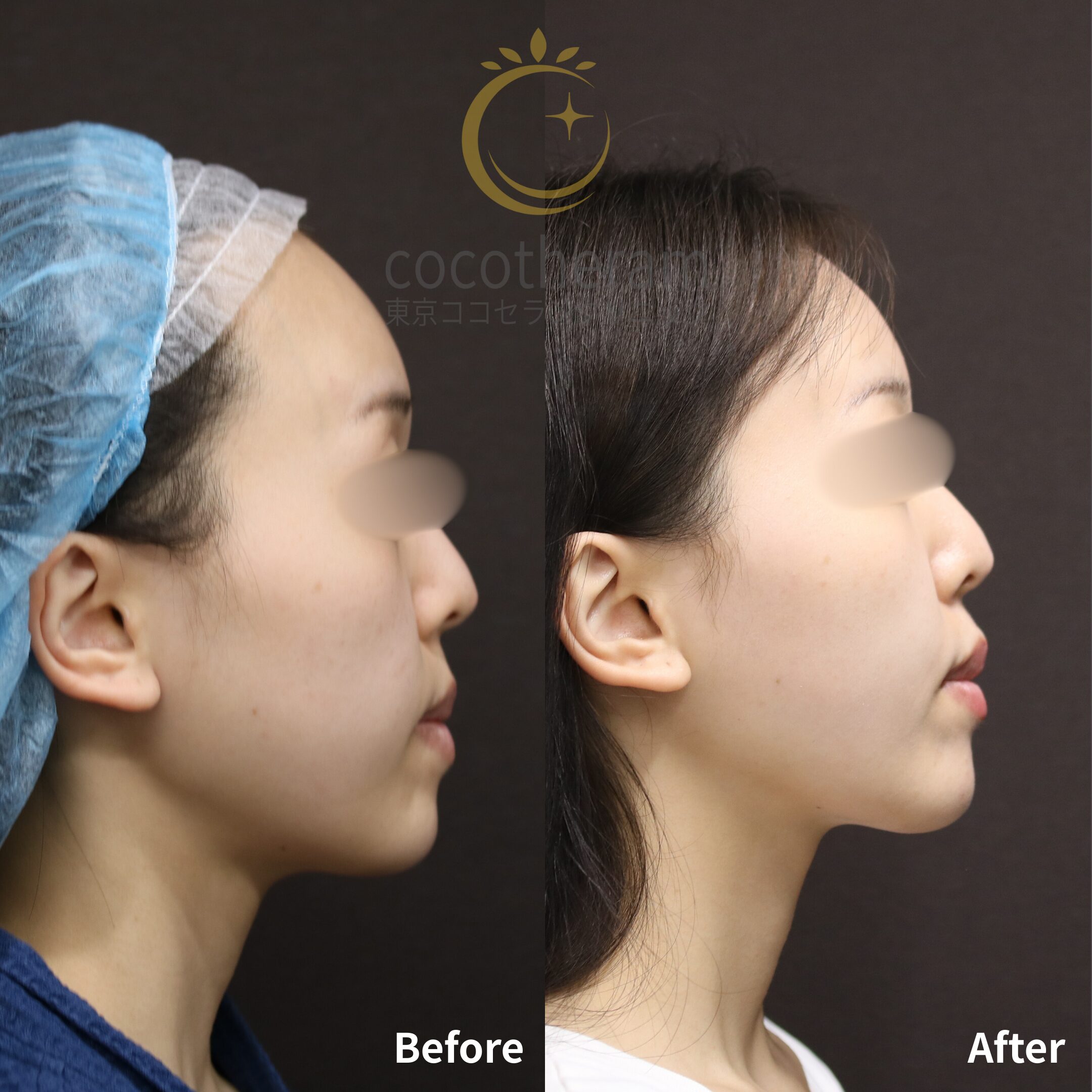 小顔マジック / 脂肪注入