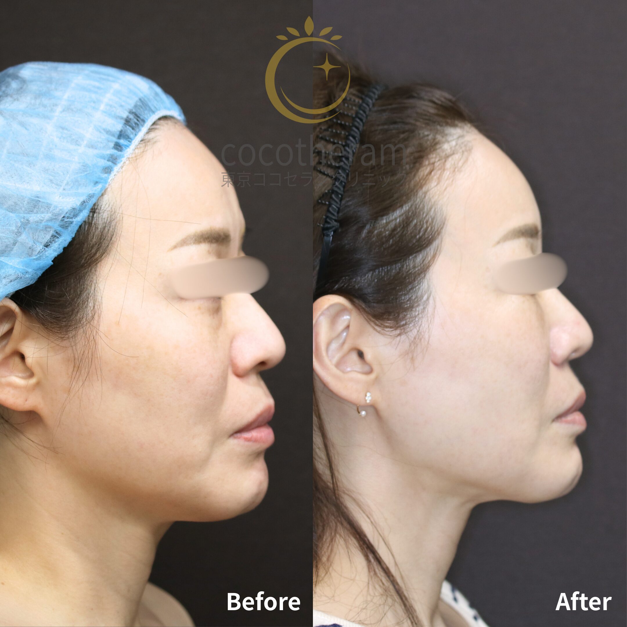 小顔マジック / ミッドフェイスリフト / 表ハムラ法