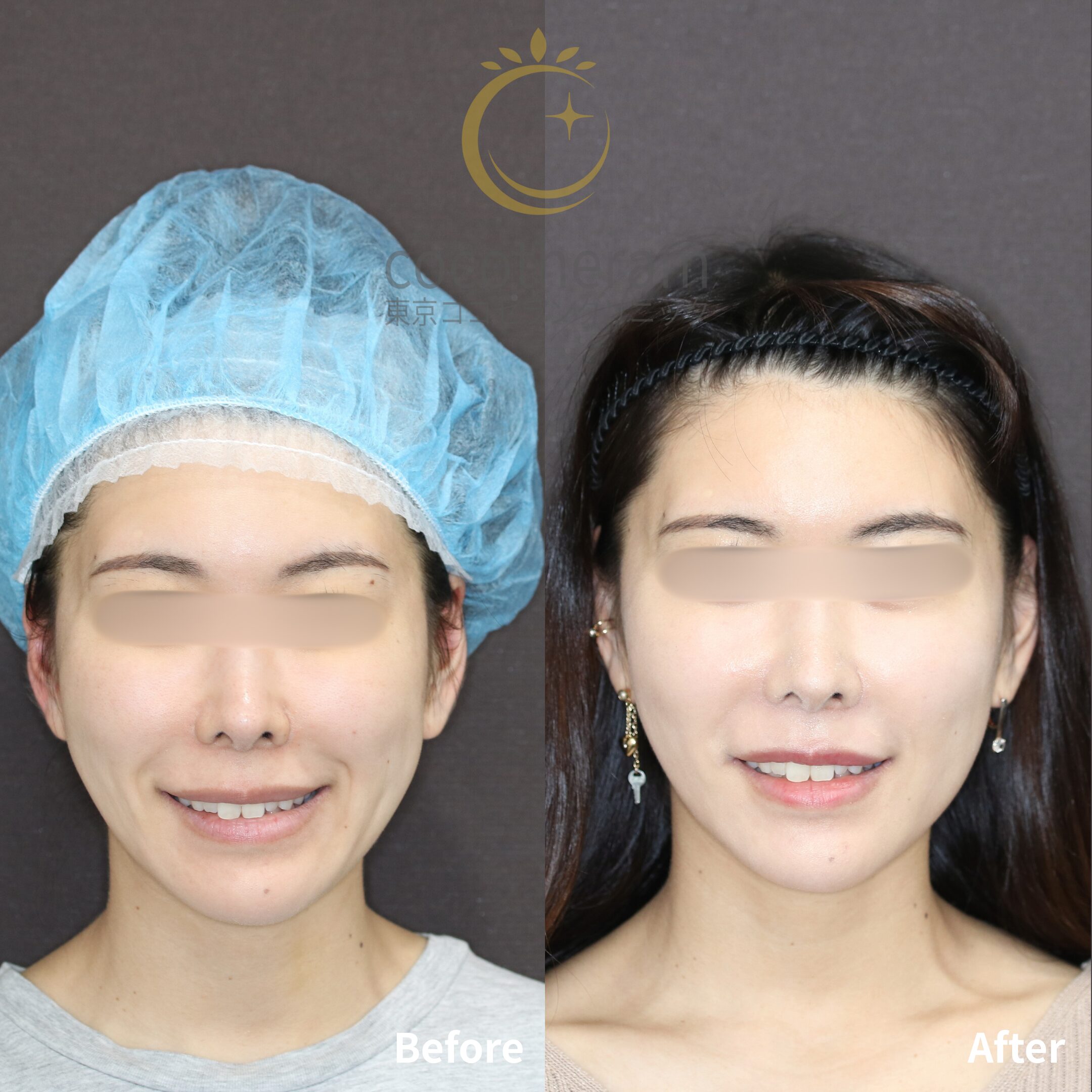 スレッドリフト