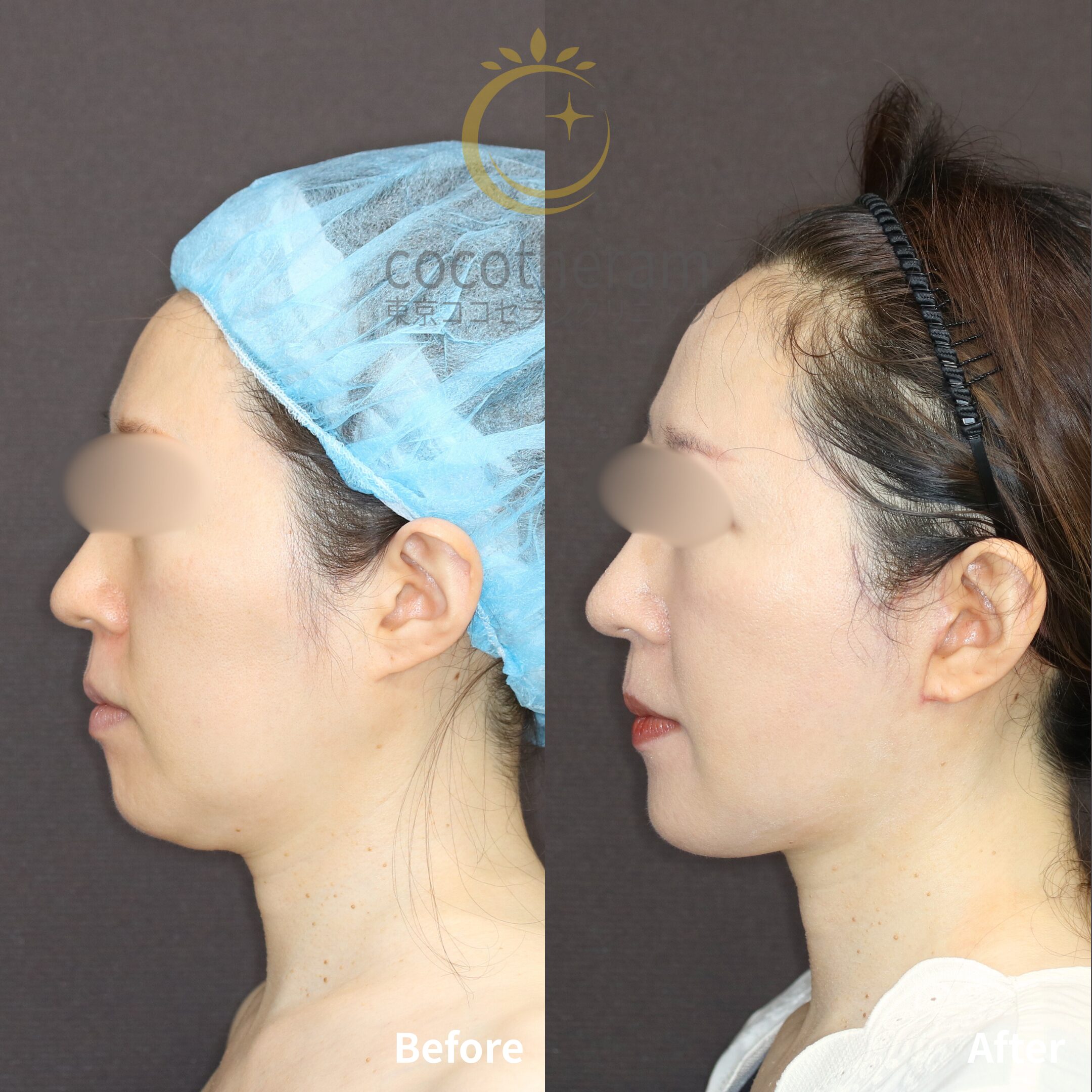 トータルフェイスリフト / 脂肪吸引 / 脂肪注入